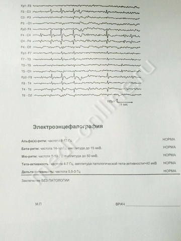 Образец справки ЭЭГ (электроэнцефалограмма) для водительских прав в Москве